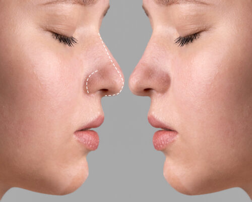 Nose Shape Correction Understanding Your Options