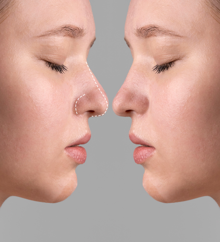 Nose Shape Correction Understanding Your Options